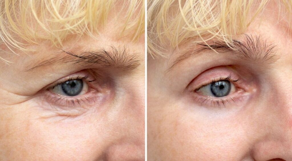 Crème anti-rides contour des yeux appliquée du bout des doigts sur une peau fine