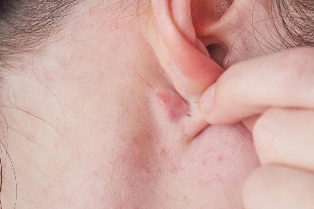 Kyste derrière l'oreille : petite boule sous la peau à la base du pavillon