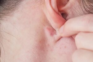 Kyste derrière l'oreille : petite boule sous la peau à la base du pavillon