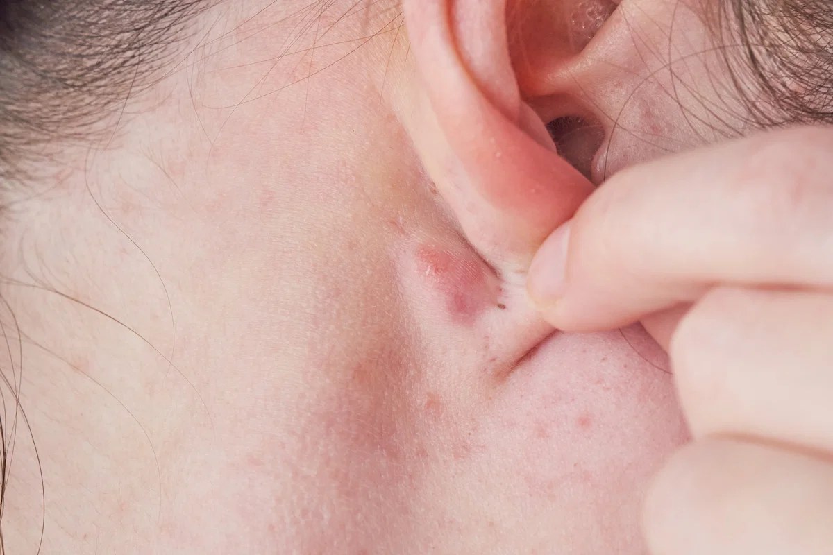 Illustration de l'article Kyste derrière l’oreille : reconnaître cette boule sous la peau et savoir quand s’inquiéter